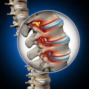 Spinal Stenosis Treatment in Frisco